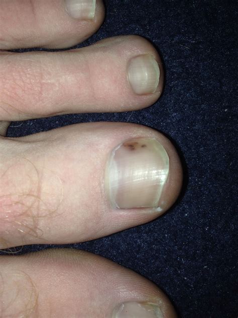 black spot under toenail melanoma pictures